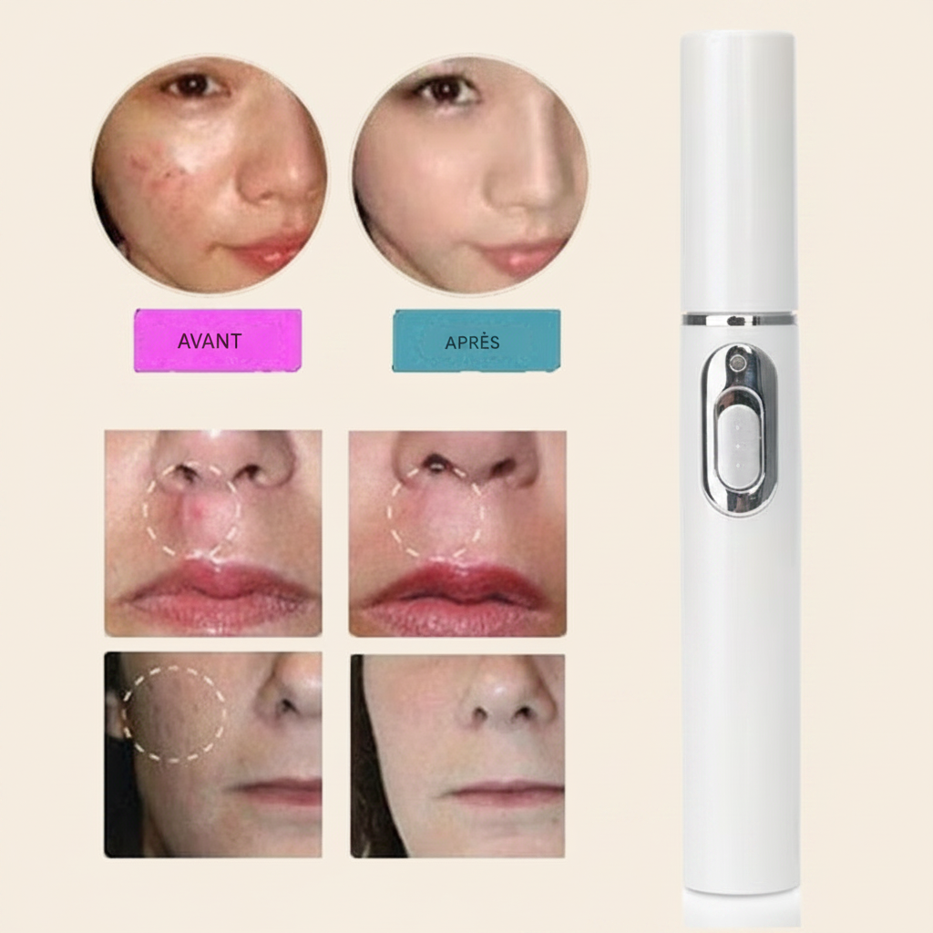Stylo laser anti-acné et thérapie du visage par luminothérapie LED bleue